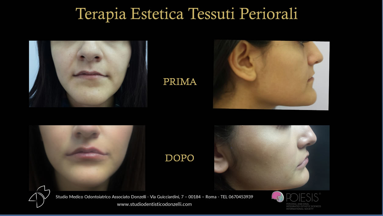 Terapia estetica tessuti periorali - Studio Medico Odontoiatrico Donzelli