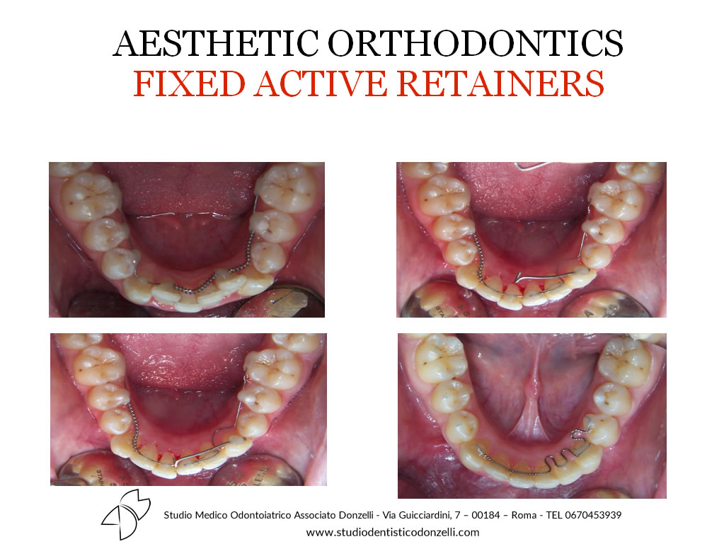 Aesthetic Orthodontics Fixed Active Retainers - Studio Medico Odontoiatrico Donzelli