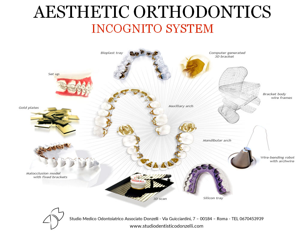 Aesthetic Orthodontics Incognito System - Studio Medico Odontoiatrico Donzelli