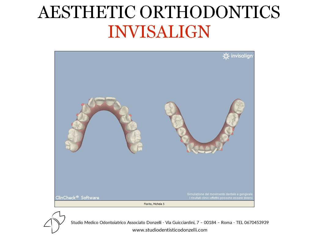 Aesthetic Orthodontics Invisalign - Studio Medico Odontoiatrico Donzelli