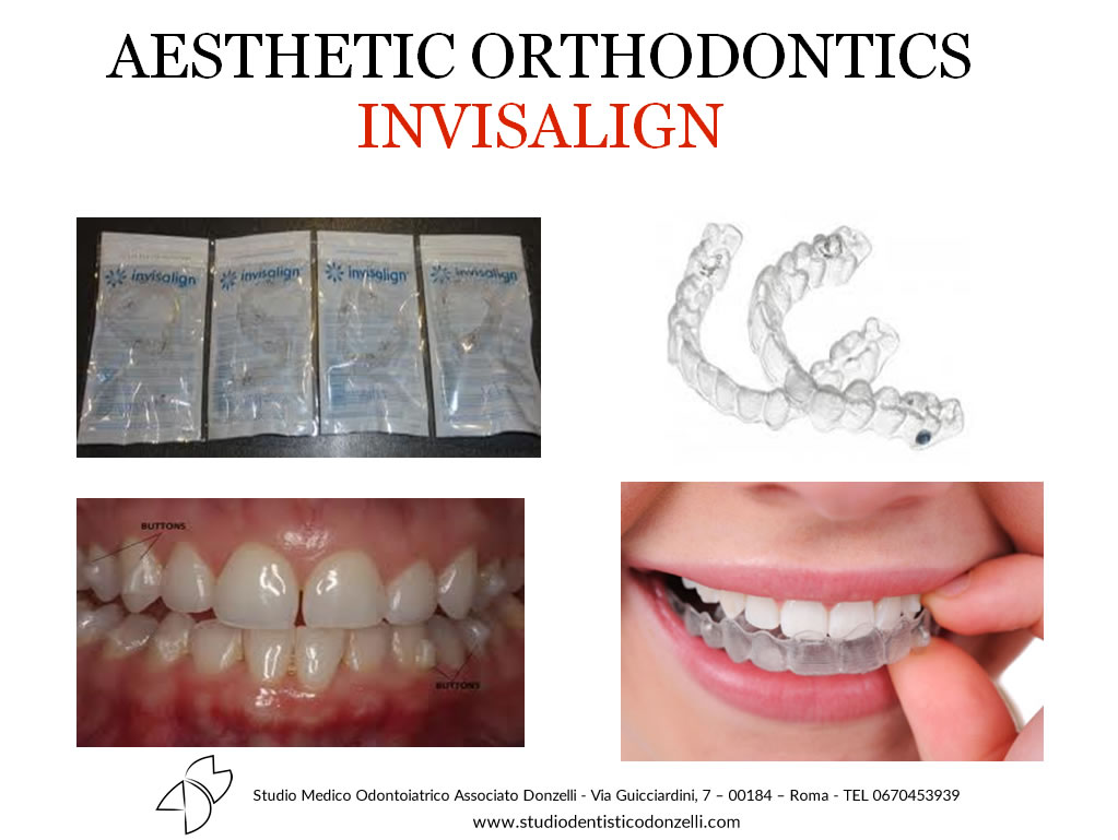Aesthetic Orthodontics Invisalign - Studio Medico Odontoiatrico Donzelli